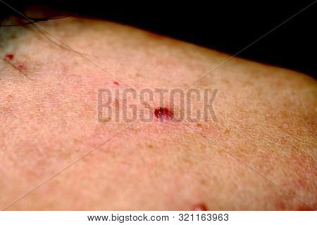 Torn Off A Bleeding Pimple On The Skin. Inflammation, Acne.
