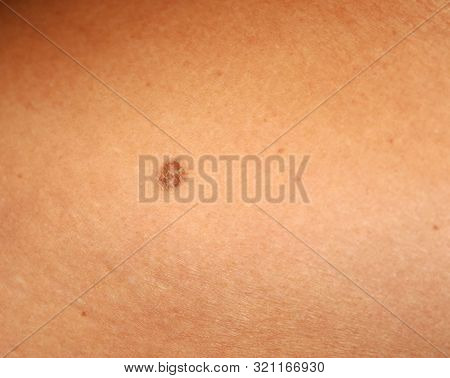 Brown Spots On The Skin. Spot Dark.