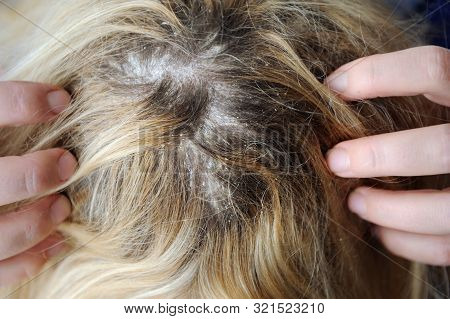 Dandruff Seborrhea Problem Of Scalp And Hair Treatment Of Peeling From Allergies Or Lichen