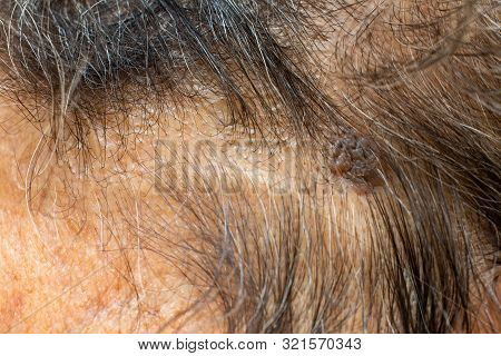 Black & Brown Mole On Senior Woman's Head, Medicine, Close Up & Macro Shot, Selective Focus, Body Pa