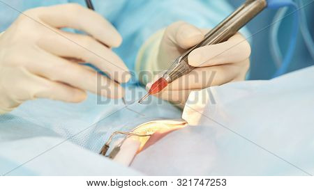 Ophthalmology Laser Microscope Operation. Doctor In Clinic. Patient Eye Treatment. Myopia And Catara