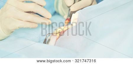 Ophthalmology Laser Microscope Operation. Doctor In Clinic. Patient Eye Treatment. Myopia And Catara
