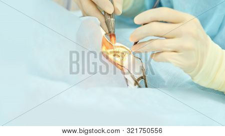 Ophthalmology Laser Microscope Operation. Doctor In Clinic. Patient Eye Treatment. Myopia And Catara