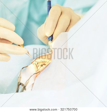 Ophthalmology Laser Microscope Operation. Doctor In Clinic. Patient Eye Treatment. Myopia And Catara