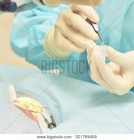 Ophthalmology Laser Microscope Operation. Doctor In Clinic. Patient Eye Treatment. Myopia And Catara