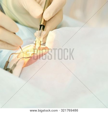 Ophthalmology Laser Microscope Operation. Doctor In Clinic. Patient Eye Treatment. Myopia And Catara