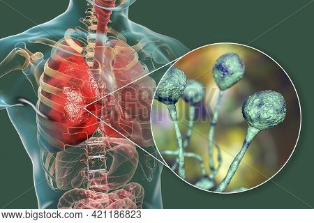 Lung Mucormycosis, A Lung Disease Caused By Fungi Mucor, Also Known As Black Fungus, With Close-up V