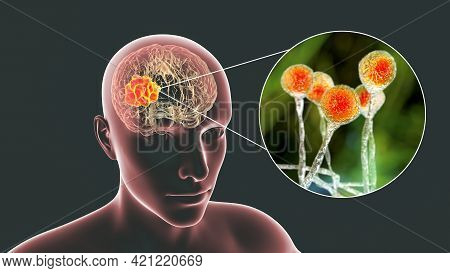 Brain Mucormycosis, A Brain Lesion Caused By Fungi Mucor, Also Known As Black Fungus, With Close-up 
