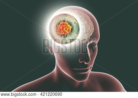 Brain Mucormycosis, A Brain Lesion Caused By Fungi Mucor, Also Known As Black Fungus, 3d Illustratio