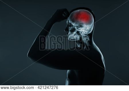 X-ray Of A Man's Head. Medical Examination Of Head Injuries. Cerebral Stroke. Brain Damage Is Highli
