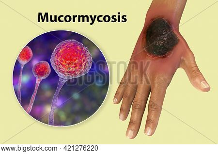 Cutaneous Mucormycosis, A Disease Caused By Fungi Mucor, Also Known As Black Fungus, 3d Illustration