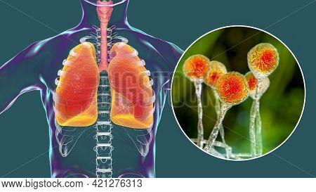 Lung Mucormycosis, A Lung Disease Caused By Fungi Mucor, Also Known As Black Fungus, With Close-up V