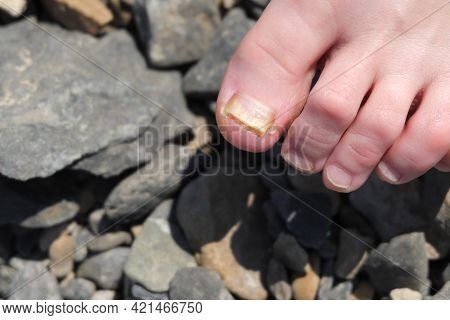Fungal Nail Disease. Toenail Damaged By An Intractable Fungal Disease. Selective Focus.