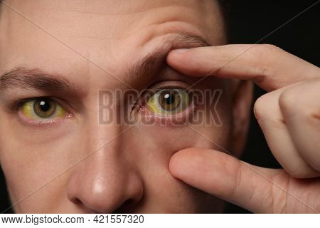 Man Checking His Health Condition On Black Background, Closeup. Yellow Eyes As Symptom Of Problems W