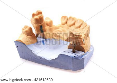 Model Of Tooth Prothesis