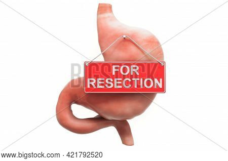 Gastric Resection Concept. Human Stomach With For Resection Hanging Sign, 3d Rendering