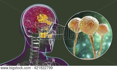 Rhinocerebral Mucormycosis, A Brain Lesion And Sinusitis Caused By Fungi Mucor