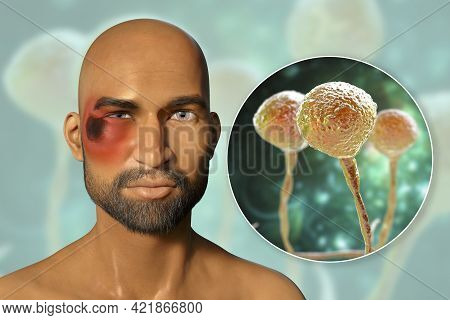Periorbital Cutaneous Mucormycosis, A Disease Caused By Mucor Fungi