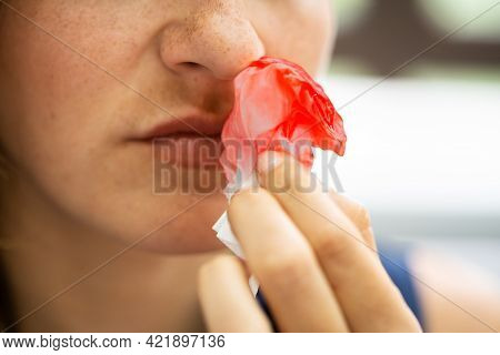 Woman Trying To Stop Blood Bleeding From Nose