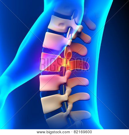 L2 Disc - Lumbar Spine
