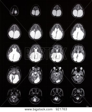 Agy Mri mutatja megnagyobbodott Venticles