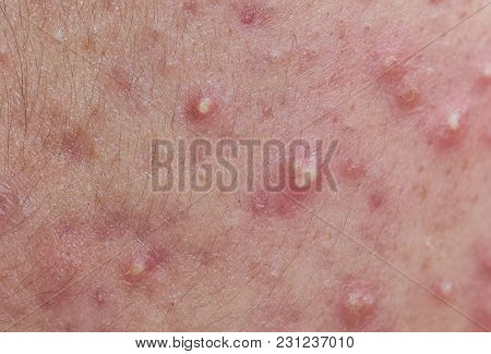 Acne On Facial Skin, Dermatological Disease Acne