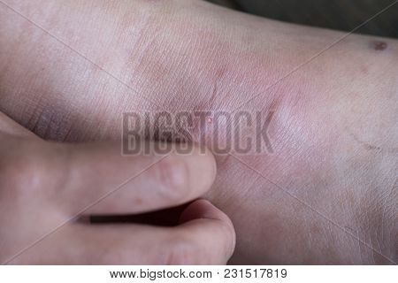 Wound Leg, Diabetic Foot Syndrome.