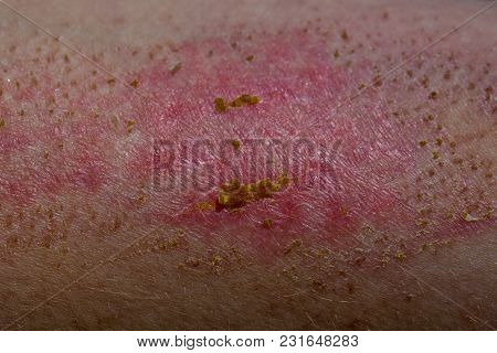 Skin Ailment Or Disease Closeup. Wound On The Skin Heals, Crusts. Human Body With Dermatitis. Atopic