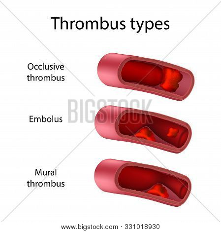 Thrombus Types, Occlusive, Embolus, Mural. Medical Anatomy Illustration.