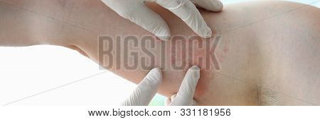 Male Doctor In White Protective Gloves Examines Patient With Skin Disease Against Office Background.