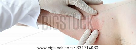 Male Doctor In White Latex Gloves Examines Patient With Skin Disease Against Office Background. Alle