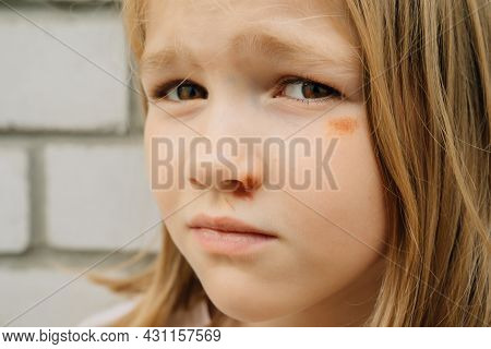Portrait Girl With An Abrasion Under Her Eye. Child Abuse. Wounds And Abrasions