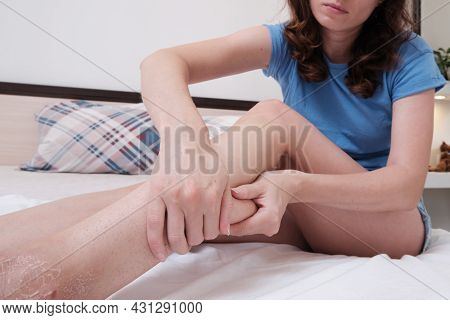 A Woman Sitting On The Bed Massages Her Leg After A Fracture. Home Rehabilitation After Injury. Mass