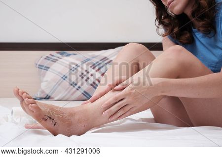 A Woman Sitting On The Bed Massages Her Leg After A Fracture. Home Rehabilitation After Injury. Mass