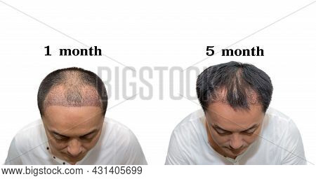 Hair Transplantation Surgery Steps. Patient Before And After The Procedure. Male Hair Loss Treatment