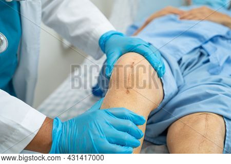 Asian Senior Or Elderly Old Lady Woman Patient Show Her Scars Surgical Total Knee Joint Replacement 
