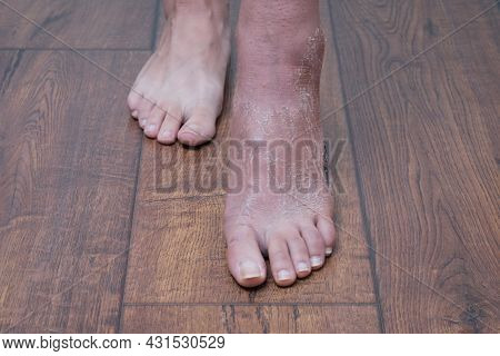 Two Legs Are On The Floor, One Leg Is Healthy, The Other Leg After A Cast. Differences Between Healt