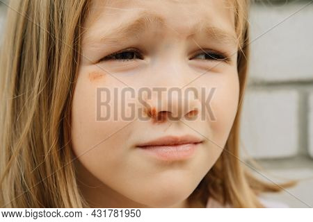 Portrait Girl With An Abrasion Under Her Eye. Child Abuse. Wounds And Abrasions