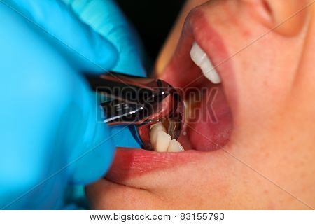 Dental Extraction