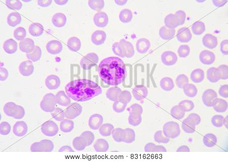 Pmn With Toxic Granule