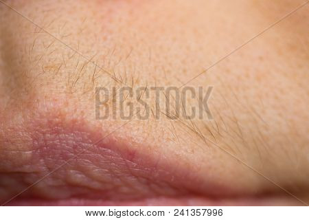Small Hairs Above Lips