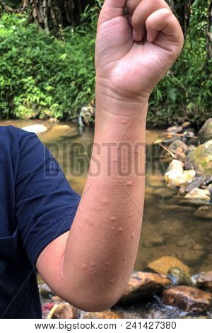 Psoriasis On Young Boy Hand With Macular Eruption, Rash And Patches On Skin. Allergy From Insect, Pl