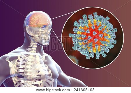 Measles-induced Encephalitis, Medical Concept, 3d Illustration Showing Brain Infection And Close-up 