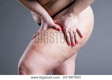 Overweight Woman With Fat Thighs, Obesity Female Legs On Gray Background