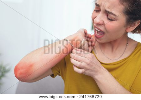 Terrible Bracelet. Young Girl Feeling Emotional And Sore From Having A Rash Caused By A Bracelet On 