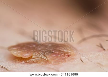 Macro Photo Of A Skin Wart, Papilloma Virus Infection