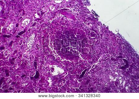Histopathology Of Acute Nephritis, Light Micrograph, Photo Under Microscope