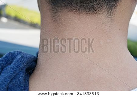 Close Up Human Skin Is Ringworm Eczema