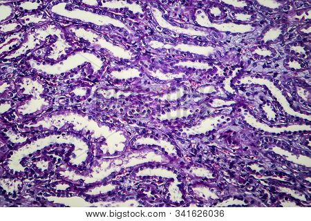 Chronic Nephritis, Light Micrograph, Photo Under Microscope