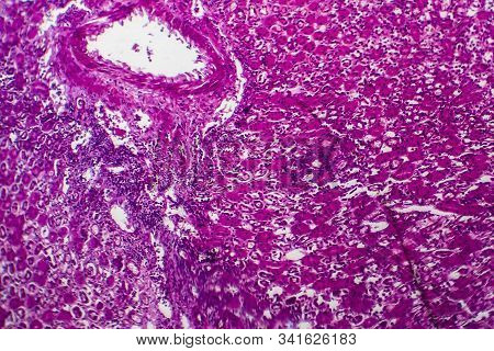 Histopathology Of Acute Nephritis, Light Micrograph, Photo Under Microscope